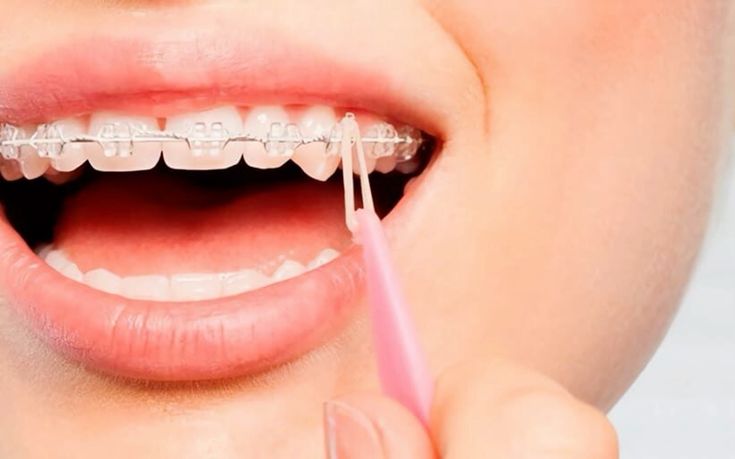 niềng 1 hàm có hiệu quả không